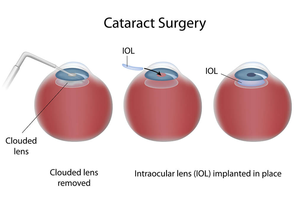 Chart Showing the Process of Cataract Surgery